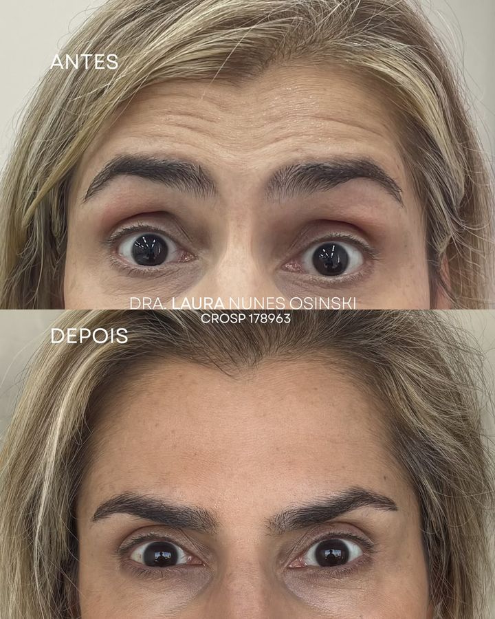 Antes e depois de aplicação de botox